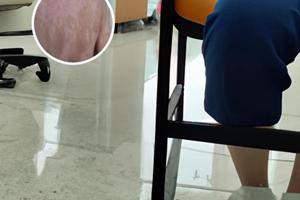 他克莫司白斑多久起效