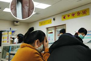 他克莫司软膏使用方法和剂量