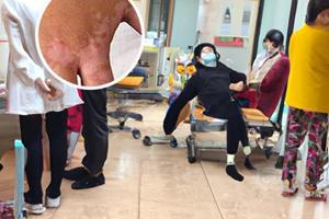 卤米松乳膏跟他克莫司可以交替使用吗