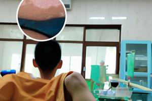 小孩脸上有白斑块是什么原因引起的