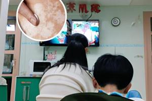小孩脸上白斑怎么治才能根除
