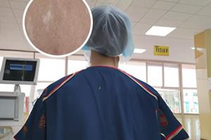 他克莫司软膏可以治疗晕痣吗