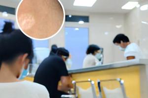 青少年晕痣不切除痣抹他克莫司可以吗