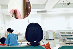 鲁索替尼乳膏的适应症