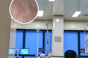 白癜风308光疗后变黑
