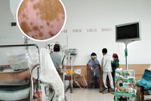 308激光治疗面部白斑需要几次痊愈