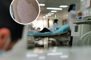他克莫司配合308治疗白癜风
