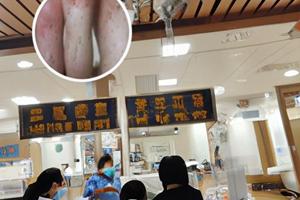 白癜风光疗308多久照一次