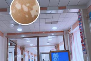 308激光治白斑的原理和作用是什么检查