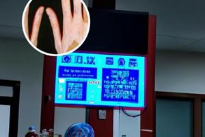308激光治疗白斑发红是怎么回事