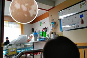 308激光治疗白斑视频大全图片
