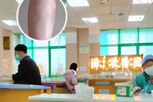 白癜风打308激光管用吗为什么