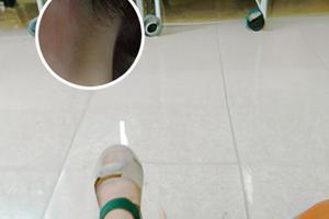 308激光治疗白癜风能不能根治