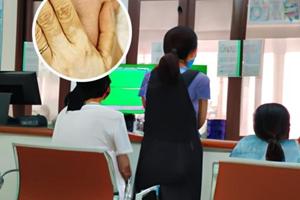 308激光治疗白癜风的原理是什么