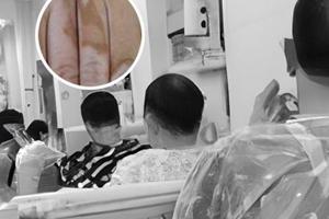 美国308nm准分子光治疗白癜风价格