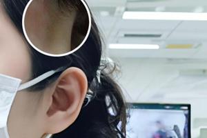 仙人掌能治白颠疯是内用吗
