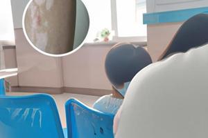 小孩儿脸上出现白斑图片大全