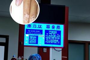他克莫司软膏含激素吗有副作用吗
