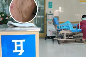 308激光治疗白斑多久见效果比较好