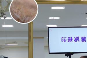 醋酸曲安奈德可以用吗
