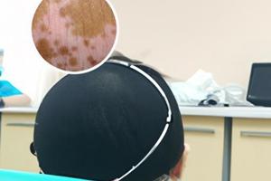 白点癫风才发现能治疗吗