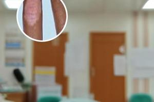用他克莫司软膏白斑能恢复过来吗怎么治疗