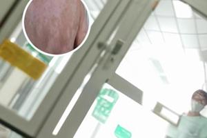 白癜风患者可以办残疾证吗