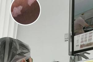 白癜风手上308