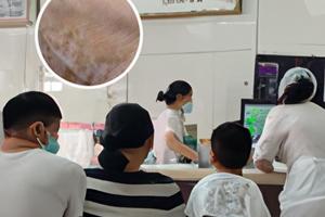 卡泊三醇凝胶治疗什么