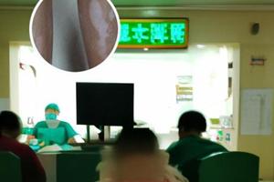 卤米松乳膏涂了变白