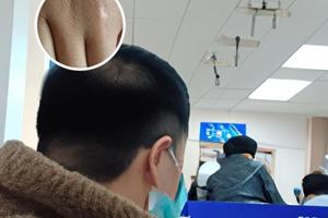 驱白巴布期片效果