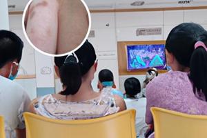 浅色白斑用他克莫司可以吗