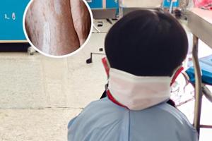 311光疗和308光疗什么区别