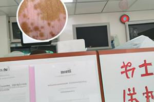 白癜风311照光多久有效果