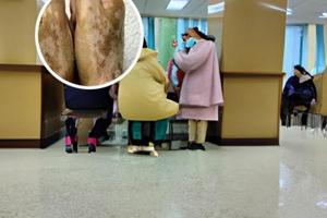 维生素d3衍生物卡泊三醇软膏有什么区别