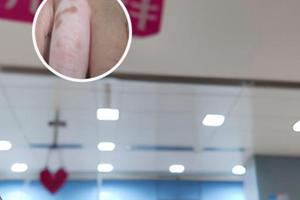 白癜风光疗多久开始长黑点