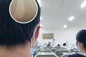 点阵激光去白斑有点痛正常吗