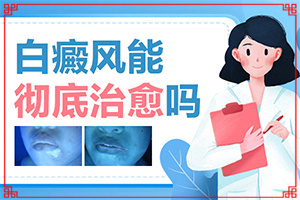 白癜风的具体症状究有哪些