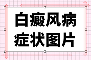 是什么因素诱发了白癜风的发生