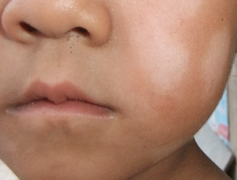 小孩脸上有白斑是怎么回事