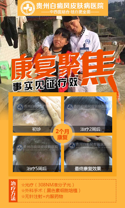 308准分子光治疗白癜风效果好吗？贵不贵？